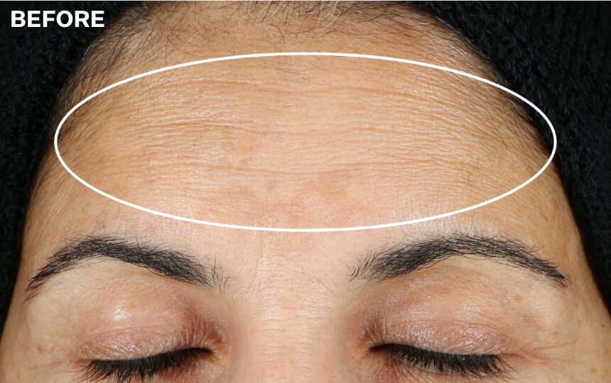 *Unretouched photos. Results after 12 weeks when used as directed. Individual results will vary.