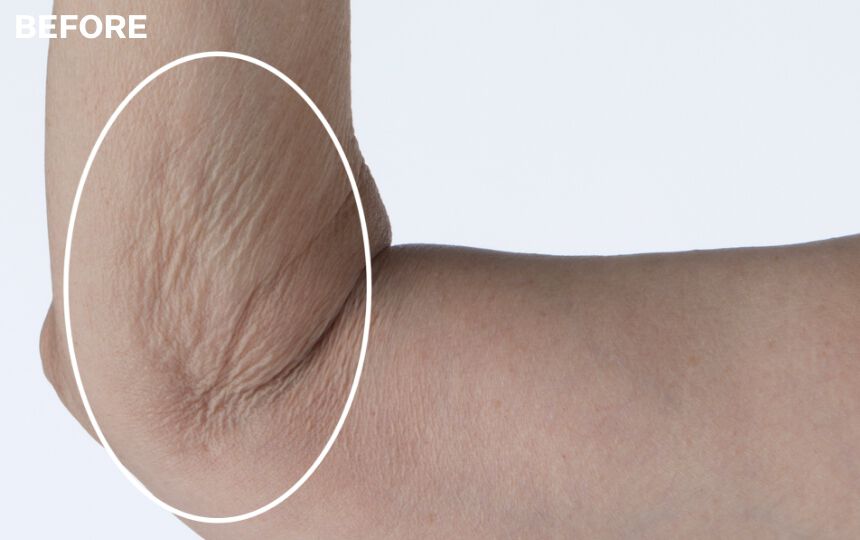 *Unretouched photos. Individual results will vary. <br>**Based on results after 4 weeks of using the Crepe Control™ Exfoliating Scrub and Tightening Body Cream.